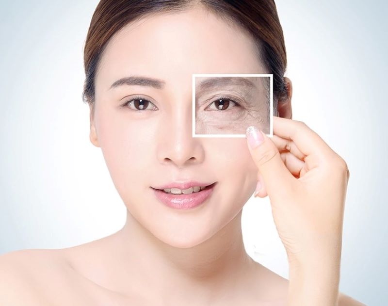 Ưu điểm và nhược điểm tiêm collagen vùng mắt